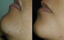 IPL_Chin