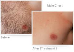 IPL_HR_Chest