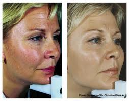 IPL_Pigment._Face