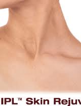 IPL_SR_Neck