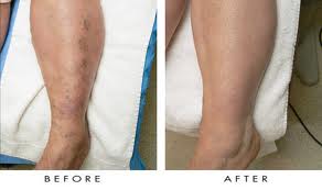 IPL_Spider_Vein_Legs