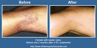 IPL_VIEN_LEG_BACK