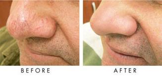 IPL_Veins_Nose