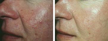 Ipl_cheeks_veins