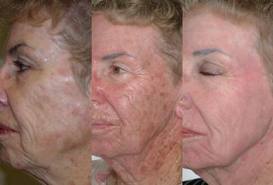 Omnilux_Before_n_After_2