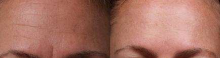 SilcSkin_Forhead