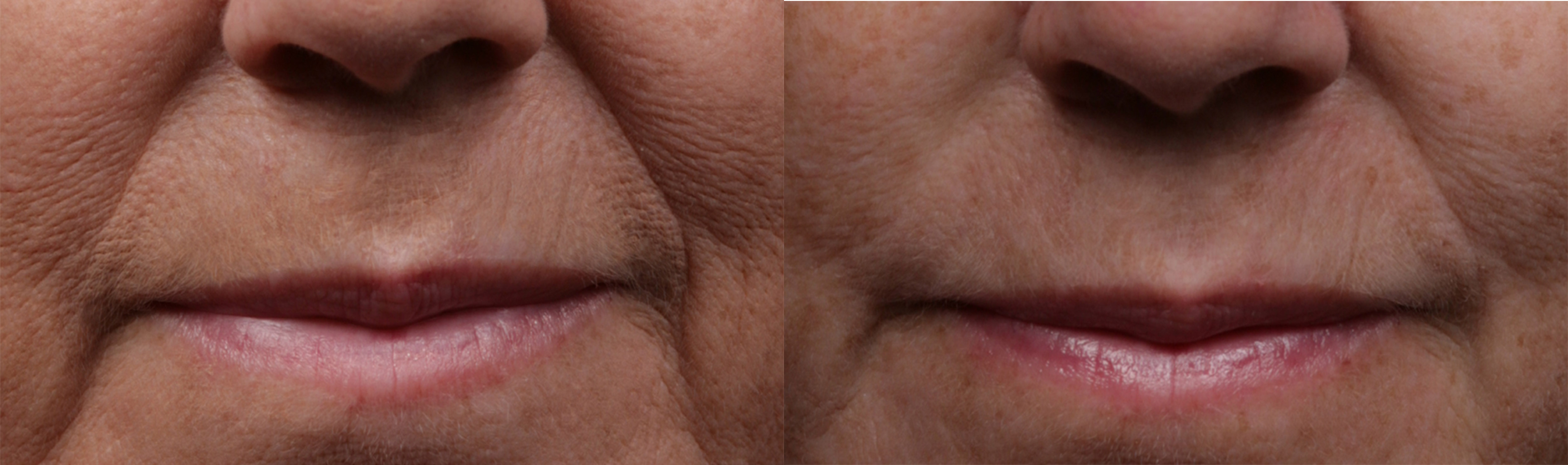 SklcSkin_Mouth_area_before_and_after