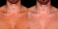 ipl_deco_red_veins