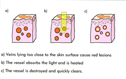 ipl_red_vein_removal_worksjpg